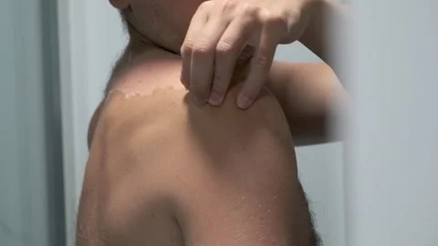 Man touching and peeling of sun damaged peeling skin with a hand on a back Stock Footage 246360389