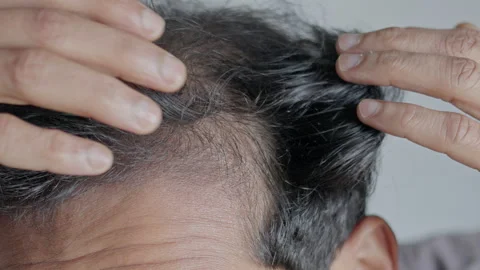 Man touching his visible bald patches. 库存影片 303326500