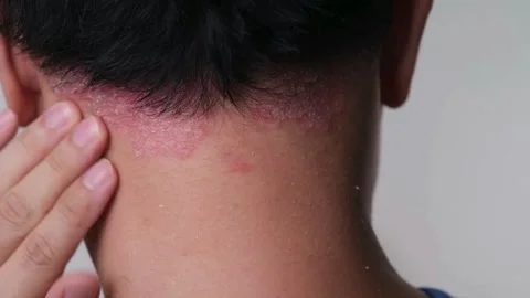 Man touching itchy psoriasis rash on his neck Stock-Footage 334873943