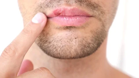 Man touching sores on the lips. herpes. lip treatment Stock Footage 77698598