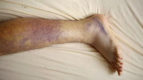 really bad leg injuries