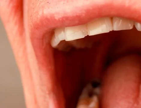 Man with two small chips on his two front teeth Stock Photos