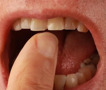Man with two small chips on his two front teeth Stock Photos