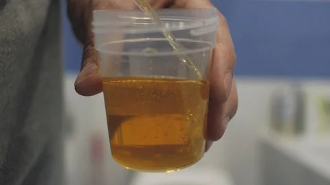 Man urinating in urine container, holding in his hand.container for analysis Stock Footage 103523166