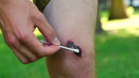 Man using cotton swap to apply hydrogen peroxide hurt joint Vidéo 207855373