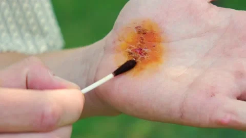Man using cotton swap to apply povidone iodine hurt hand Vidéo 207855445