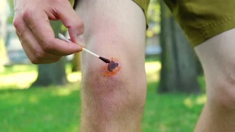 Man using cotton swap to apply povidone iodine hurt joint Stock Footage 207855517