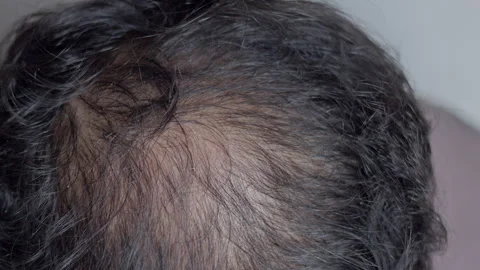 Man using derma roller on his head. Stock Footage 303326007