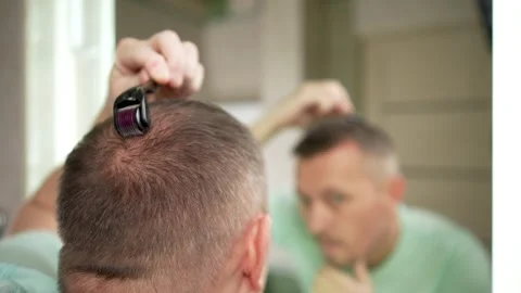 Man Using a Derma Roller on Scalp for Hair Growth Video stock 307849534