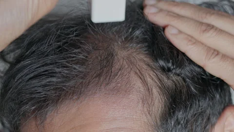Man using derma stamp on bald patches. Видео 303327103