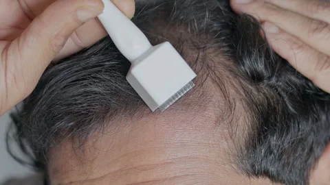 Man using derma stamp on his alopecia head. Видео 303326666