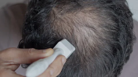 Man using derma stamp to treat hair loss. Stock Footage 303326742