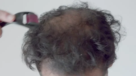 Man using dermaroller on bald patches. 库存影片 291909778