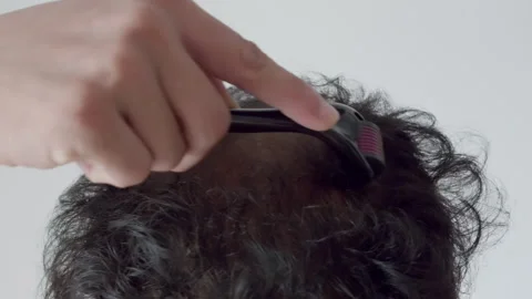 Man using dermaroller for hairloss Stock Footage 291913125