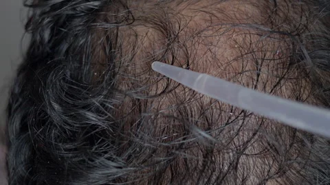 Man using essential oil on head to treat hair loss. Stock Footage 303326098