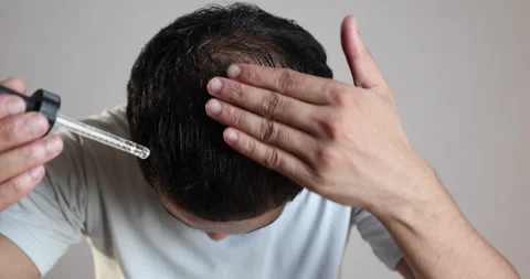 Man using minoxidil on bald scalp to treat male pattern hair loss or Stock Footage 192755630
