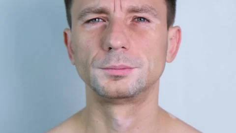 A man with vitiligo, face and head close-up Stock Footage 321863684
