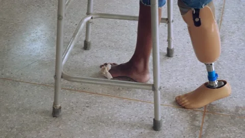 Man with walkingwith leg prosthesis Stock Footage 148641639