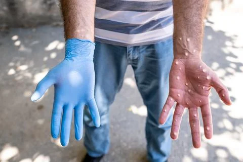 Man wearing gloves to protect from monkey virus Stock Photos