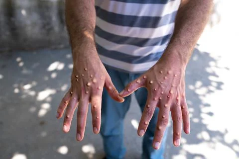 Man wearing gloves to protect from monkey virus Stock Photos
