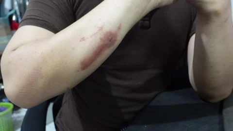 A man who feels angry because of itchy skin which causes red irritation on .. Stock Footage 320217424