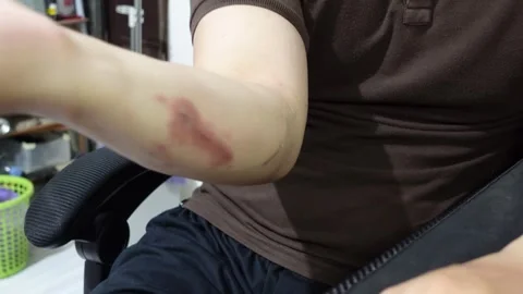 A man who feels angry because of itchy skin which causes red irritation on .. Stock Footage 320218092