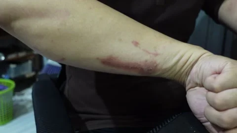 A man who feels angry because of itchy skin which causes red irritation on .. Stock Footage 320851341