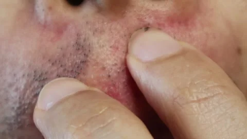 A man whose beard began falling out after laser hair removal Stock Footage 326085634