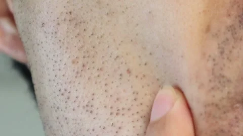 A man whose beard began falling out after laser hair removal Stock Footage 326085967