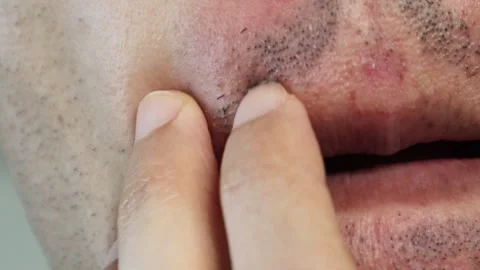 A man whose beard began falling out after laser hair removal Stock Footage 326086763