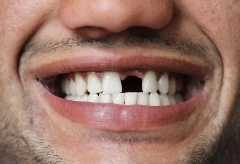 Man without a front tooth Stock Photos