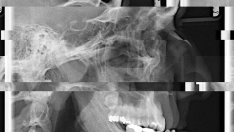 A man x-ray before and after surgery on his maxilla and mandible flicker slowly  Stock Footage 234719618