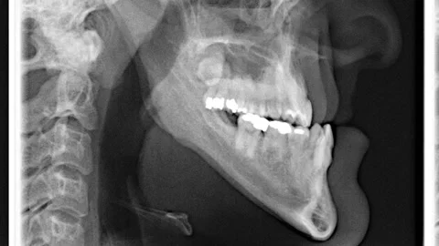 A man x-ray before surgery on his maxilla and mandible flicker slowly with a sli Stock Footage 234719486