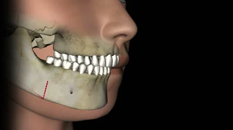 Mandibular advancement surgery animation | Stock Video | Pond5