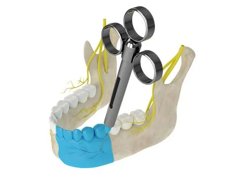 Mandibular arch with incisive nerve block Stock Illustration