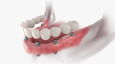 Mandibular prosthesis 6 implants Stock Footage 138883145
