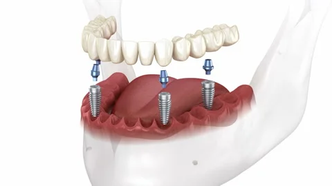 Mandibular prosthesis all on 4 system supported by implants. Stock Footage 220925956