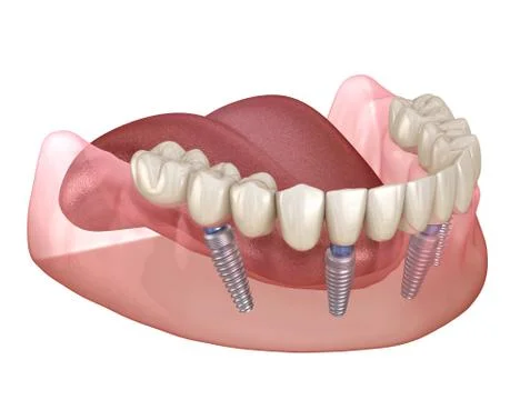 Mandibular prosthesis All on 4 system supported by implants. Medically accura Stock Illustration