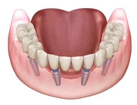 Mandibular prosthesis All on 4 system supported by implants. Medically accura Stock Illustration