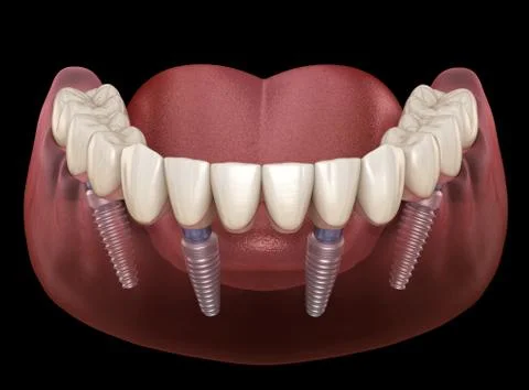 Mandibular prosthesis All on 4 system supported by implants. Medically accura Stock Illustration