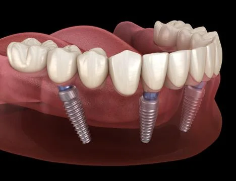 Mandibular prosthesis All on 4 system supported by implants. Medically accura Stock Illustration