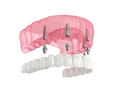 Mandibular prosthesis all on 4 system supported by implants Stock Illustration
