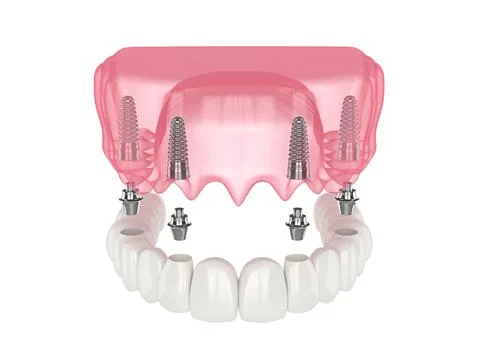 Mandibular prosthesis all on 4 system supported by implants Stock Illustration
