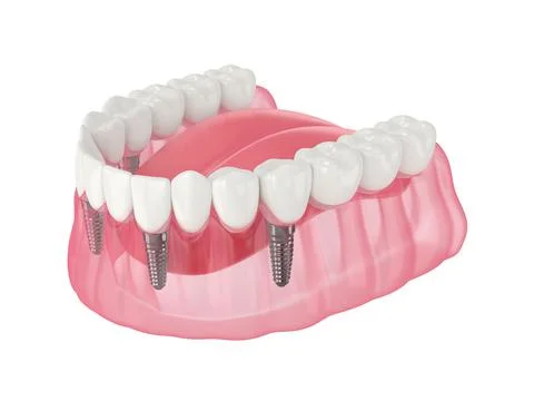 Mandibular prosthesis all on 4 system supported by implants Stock Illustration