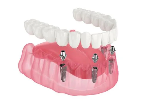 Mandibular prosthesis all on 4 system supported by implants Stock Illustration
