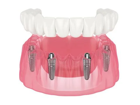 Mandibular prosthesis all on 4 system supported by implants Illustrazione stock