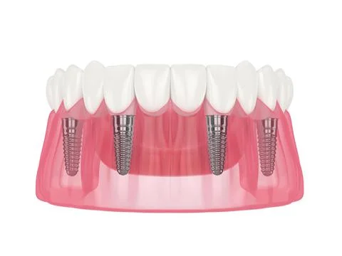 Mandibular prosthesis all on 4 system supported by implants Illustrazione stock