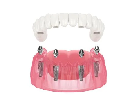 Mandibular prosthesis all on 4 system supported by implants Stock Illustration
