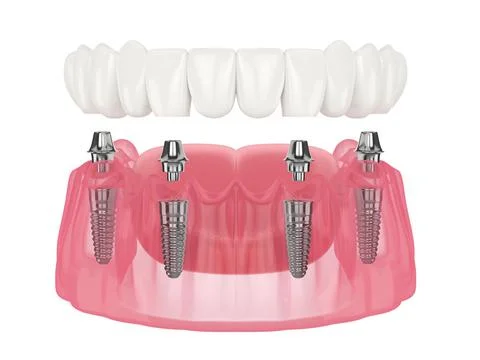 Mandibular prosthesis all on 4 system supported by implants Stock Illustration