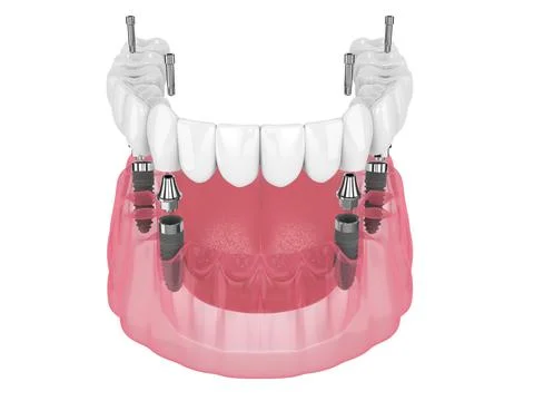 Mandibular prosthesis all on 4 system supported by implants Stock Illustration